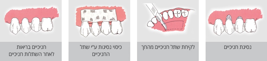 כיסוי נסיגת חניכיים על ידי שתל חניכיים