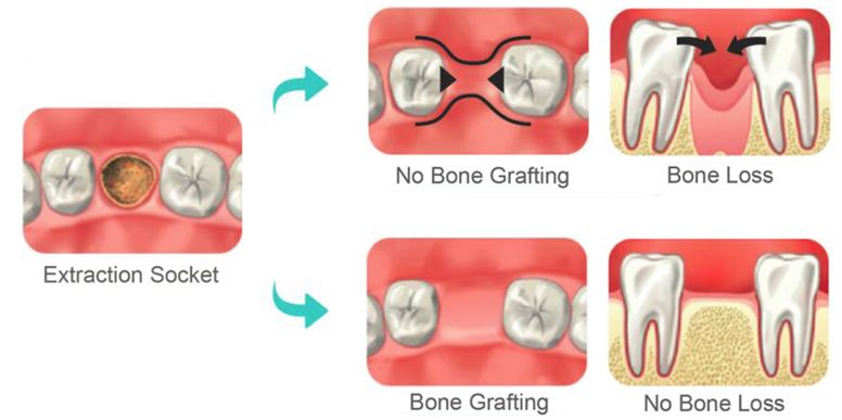 תרומת השתלת עצם