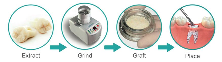 שימוש בשיניים טבעיות כמקור לבניית עצם הלסת