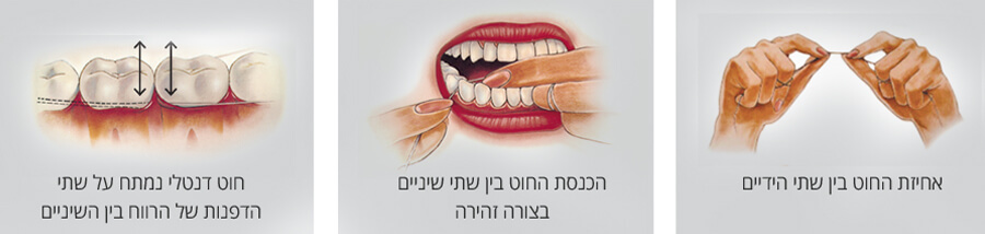 שימוש בחוט דנטלי