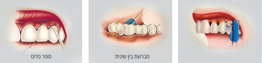 מברשת ואביזרים לניקוי בין השיניים