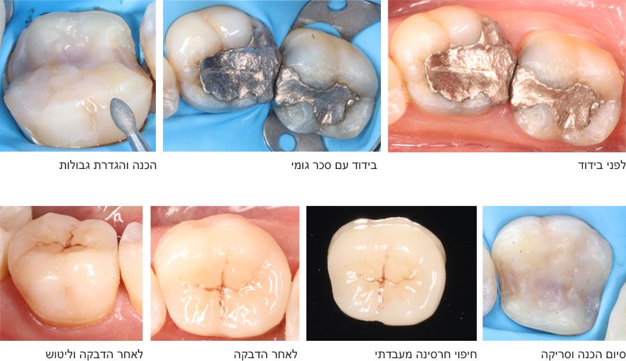 הטכניקה והתהליך לביצוע חיפוי חרסינה סגרי - דוגמאות